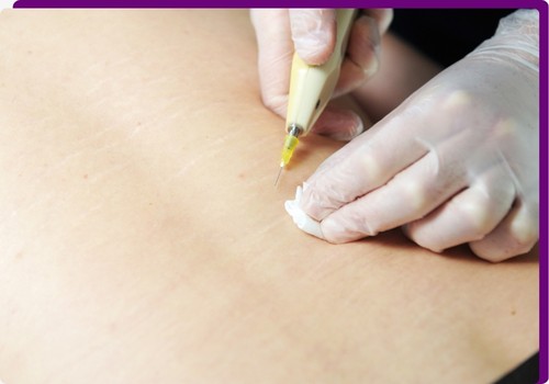 Tratamentos para estrias