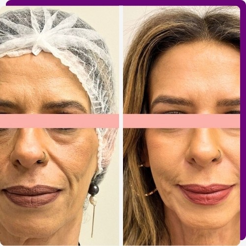 O que é o Ultraformer MPT?