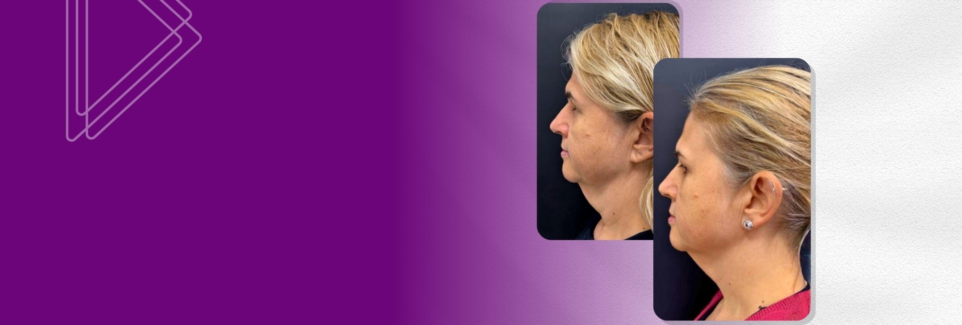 Ultraformer MPT em Porto Alegre - Lifting e firmeza sem cirurgia