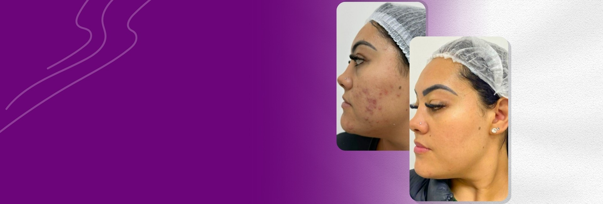Lavieen em Porto Alegre - Laser fracionado para rejuvenescimento, melasma e cicatrizes