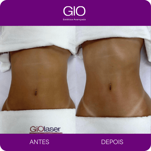 Desinchaço da barriga