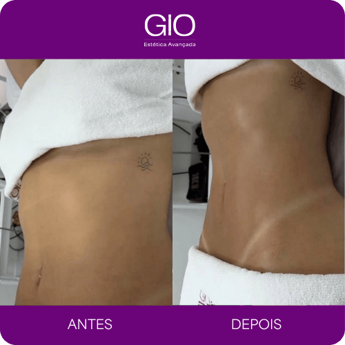 Desinchaço da barriga