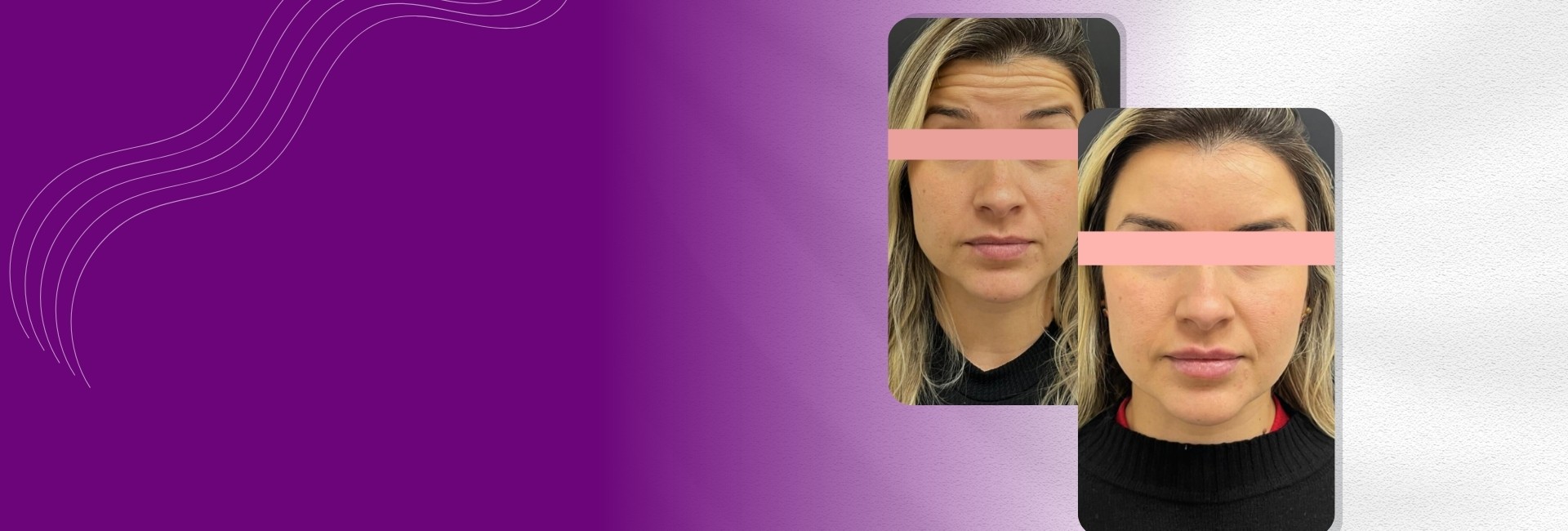 Harmonização facial