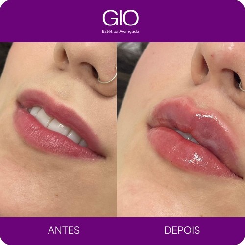 Preenchimento Labial