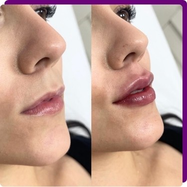 Quando fazer o preenchimento labial?