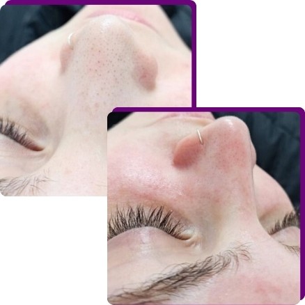 Como é feita a limpeza de pele?