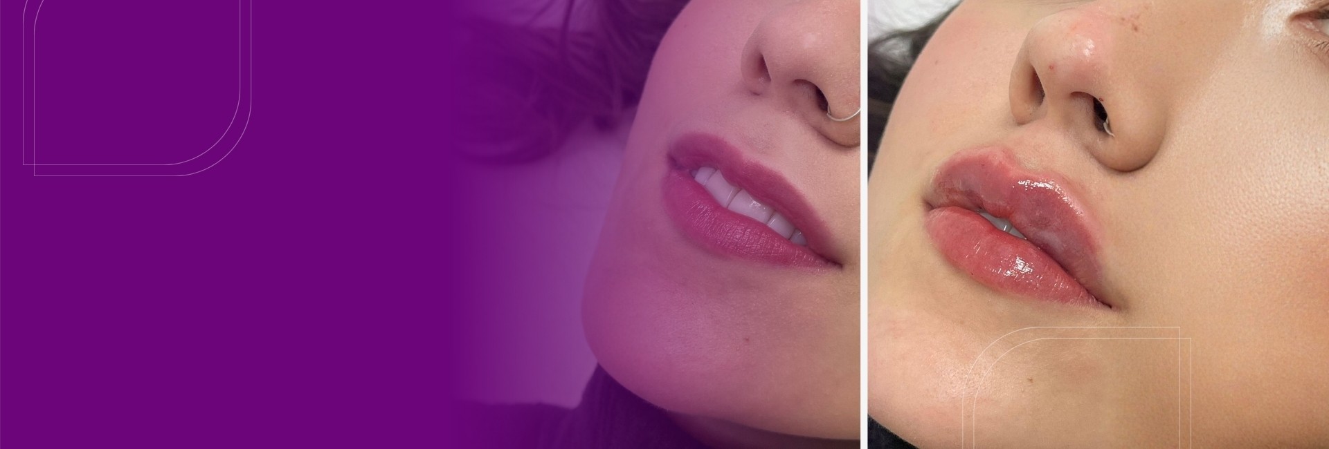 Preenchimento labial em Porto Alegre