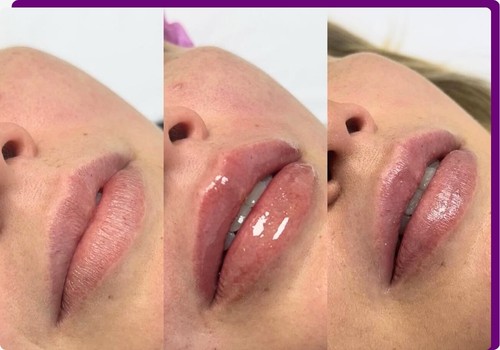 O que é o preenchimento labial?